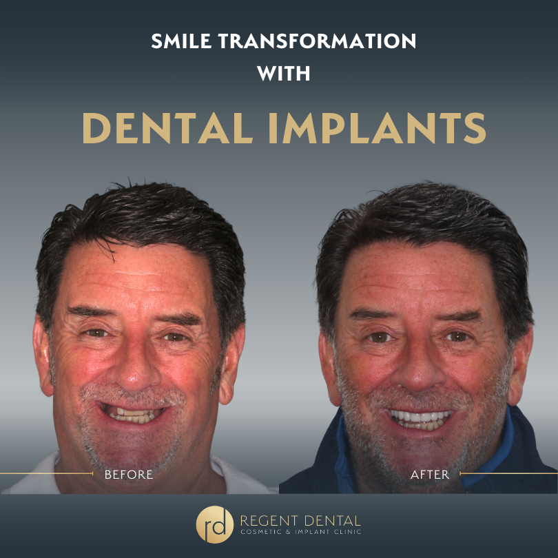 Same day smile full arch implant patient result 7