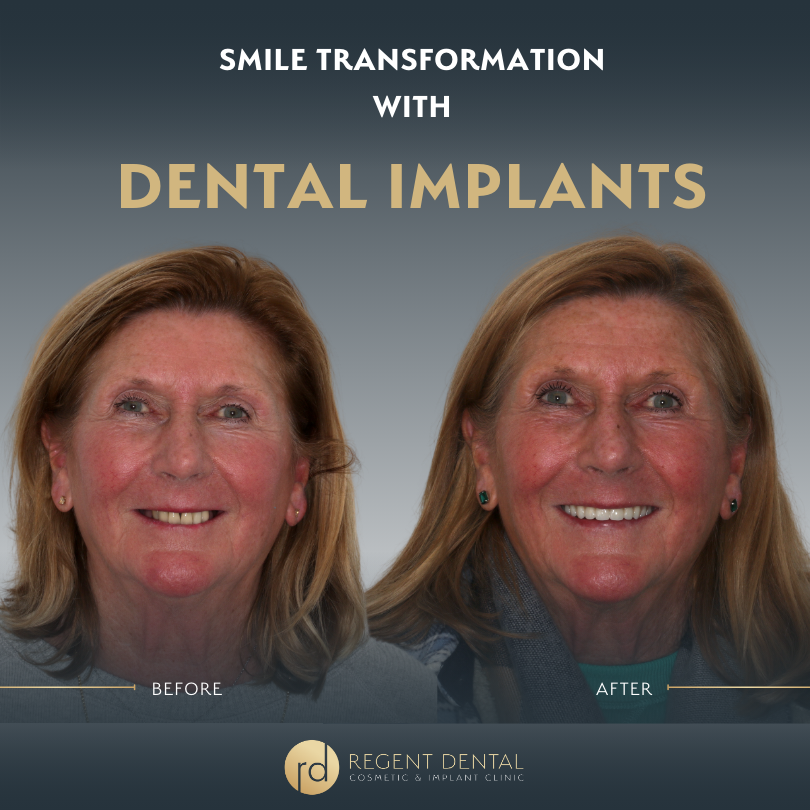 Same day smile full arch implant patient result 1