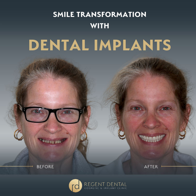 Same day smile full arch implant patient result 3