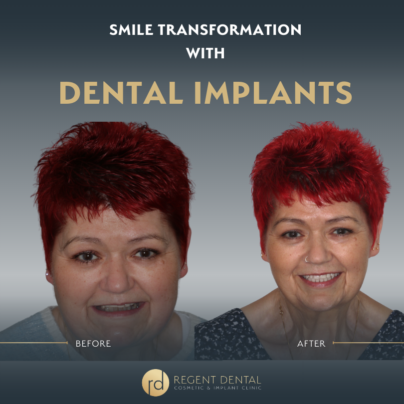 Same day smile full arch implant patient result 4