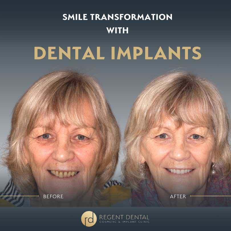 Same day smile full arch implant patient result 5