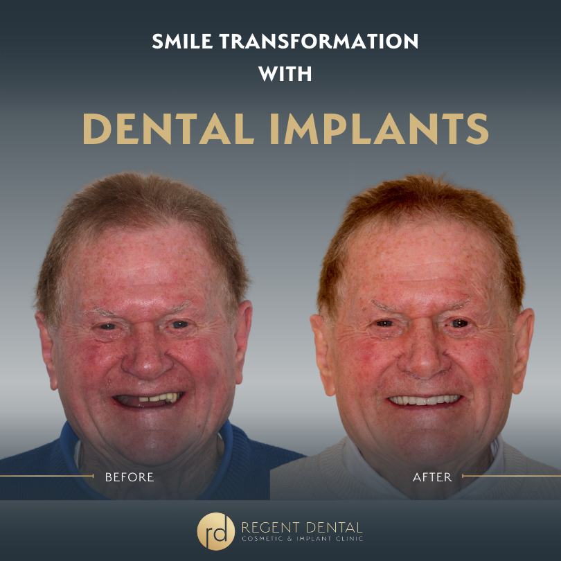 Same day smile full arch implant patient result 6
