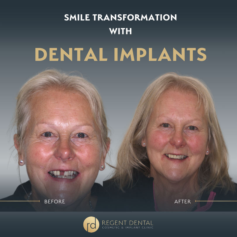 Same day smile full arch implant patient result 8