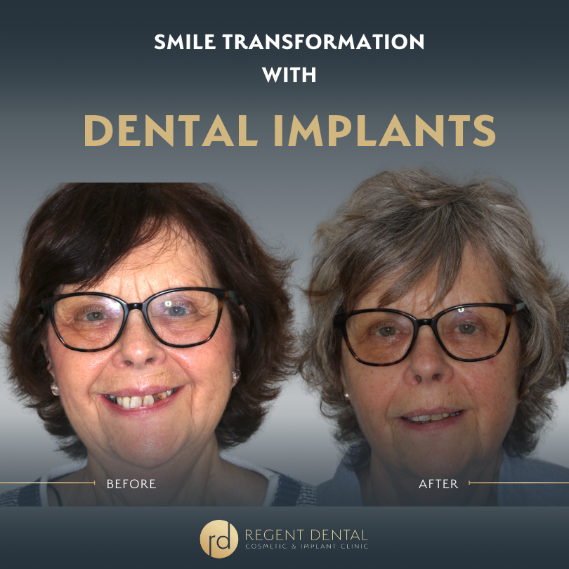 Same day smile full arch implant patient result 9