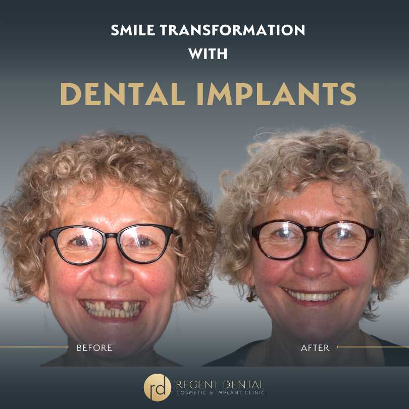 Same day smile full arch implant patient result 10