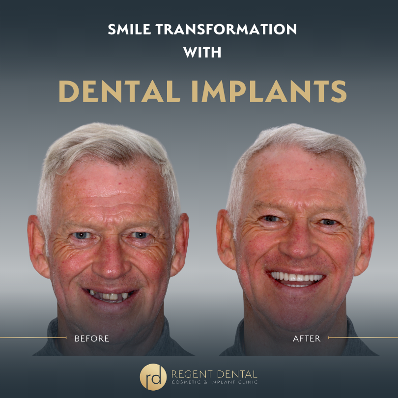 Same day smile full arch implant patient result 11