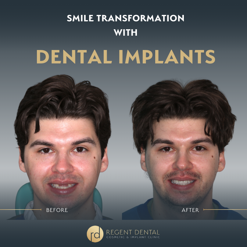 Same day smile full arch implant patient result 12