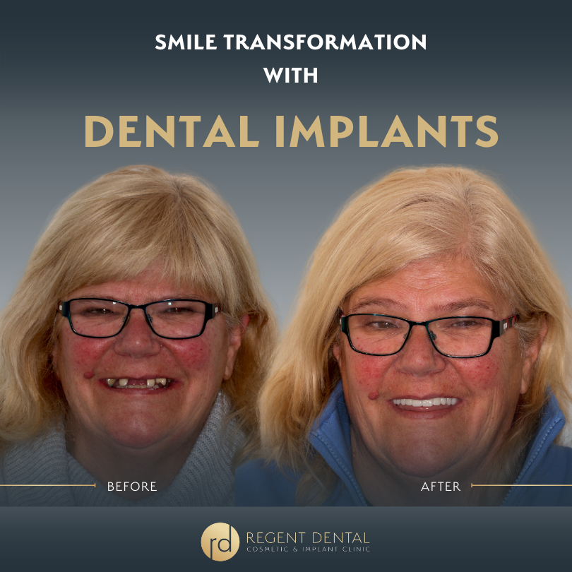 smile transformation at Regent Dental Care
