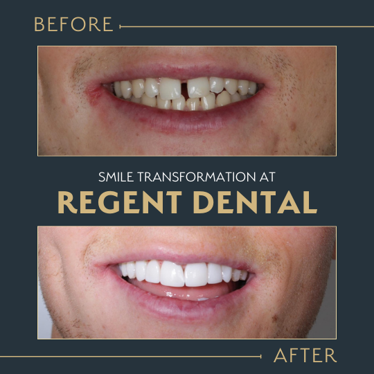 smile transformation at Regent Dental Care