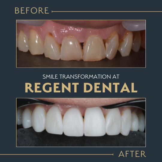 smile transformation at Regent Dental Care