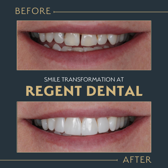 smile transformation at Regent Dental Care
