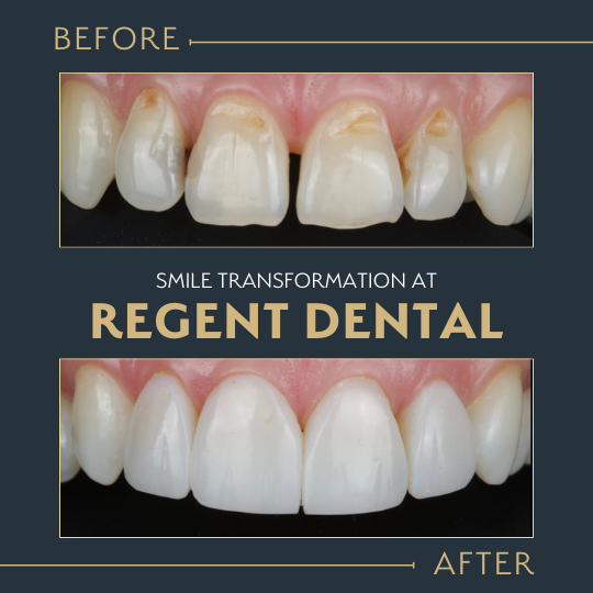 smile transformation at Regent Dental Care