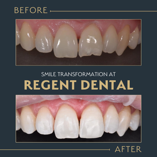 smile transformation at Regent Dental Care