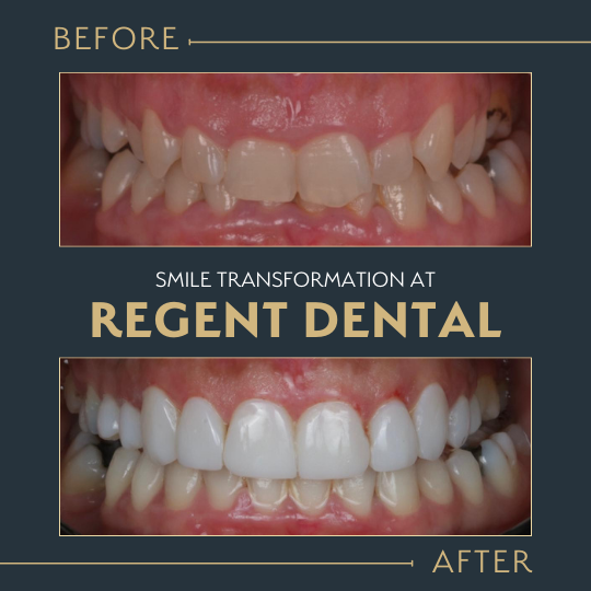 smile transformation at Regent Dental Care