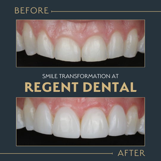 smile transformation at Regent Dental Care