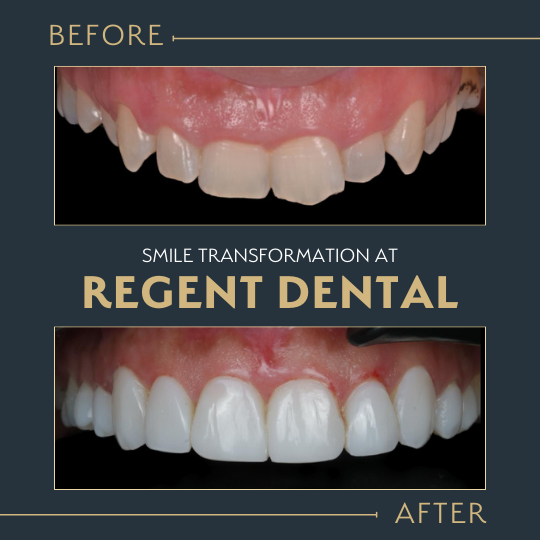 smile transformation at Regent Dental Care