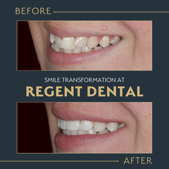 smile transformation at Regent Dental Care