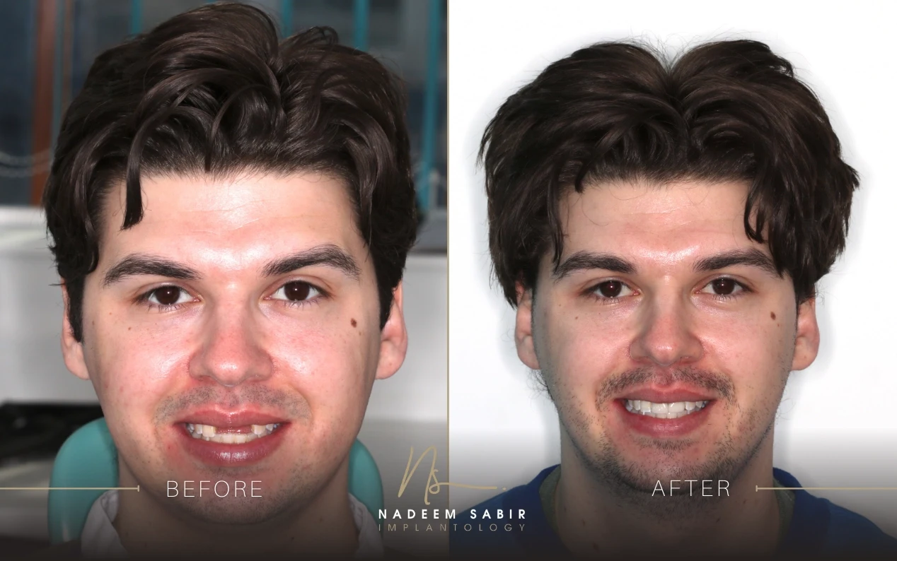 Before and after dental treatment showing a young man smiling, highlighting improved teeth alignment and appearance by Nadeem Sabir Implantology.
